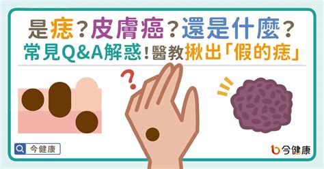 長毛痣|是痣？皮膚癌？還是什麼？常見Q&A解惑！醫教揪出「。